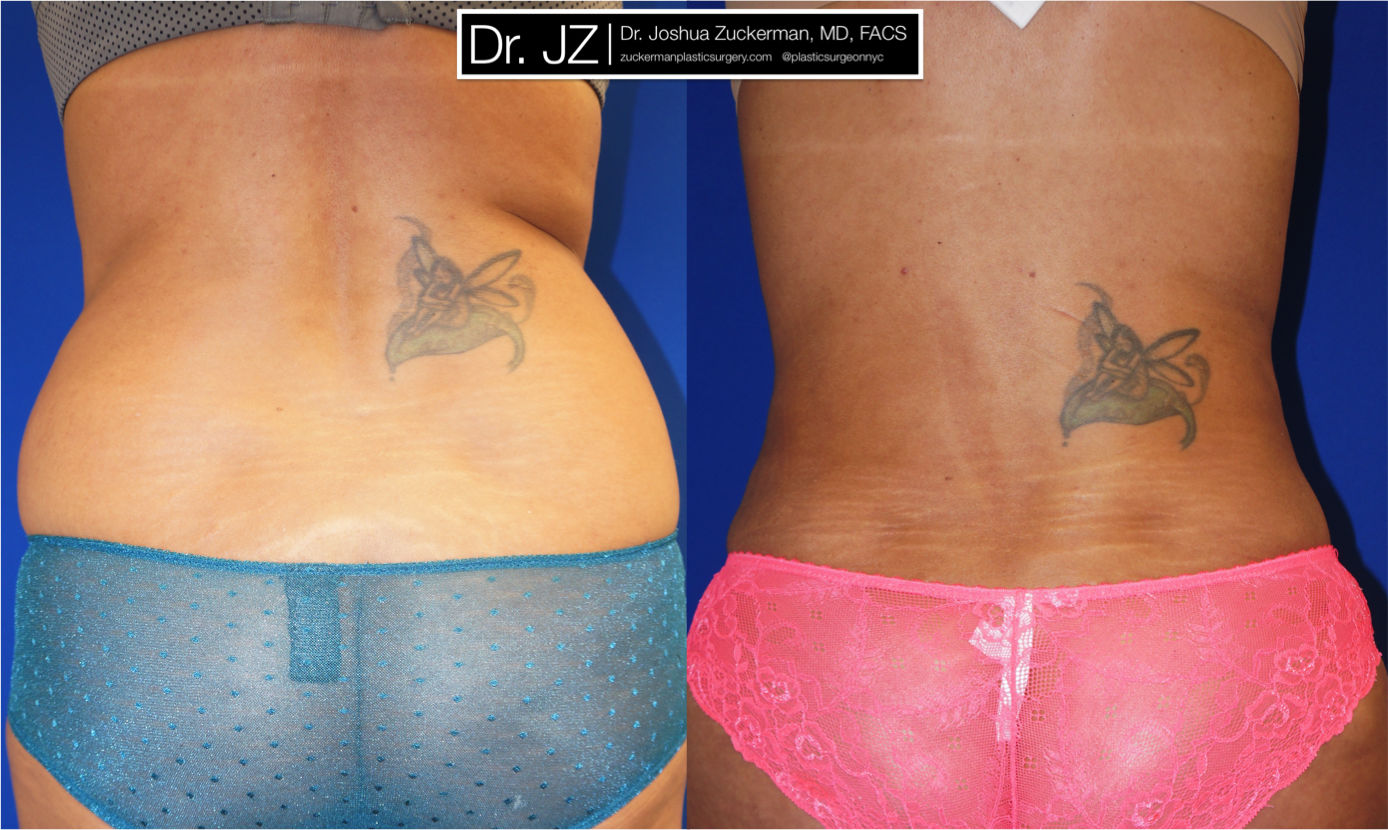 Liposuction of the abdomen, flanks, and lower back by Dr. Zuckerman. Patient, female, 1 months postop. Approximately 3.5 liters of fat removed. Fat grafting to the buttocks also performed. posterior