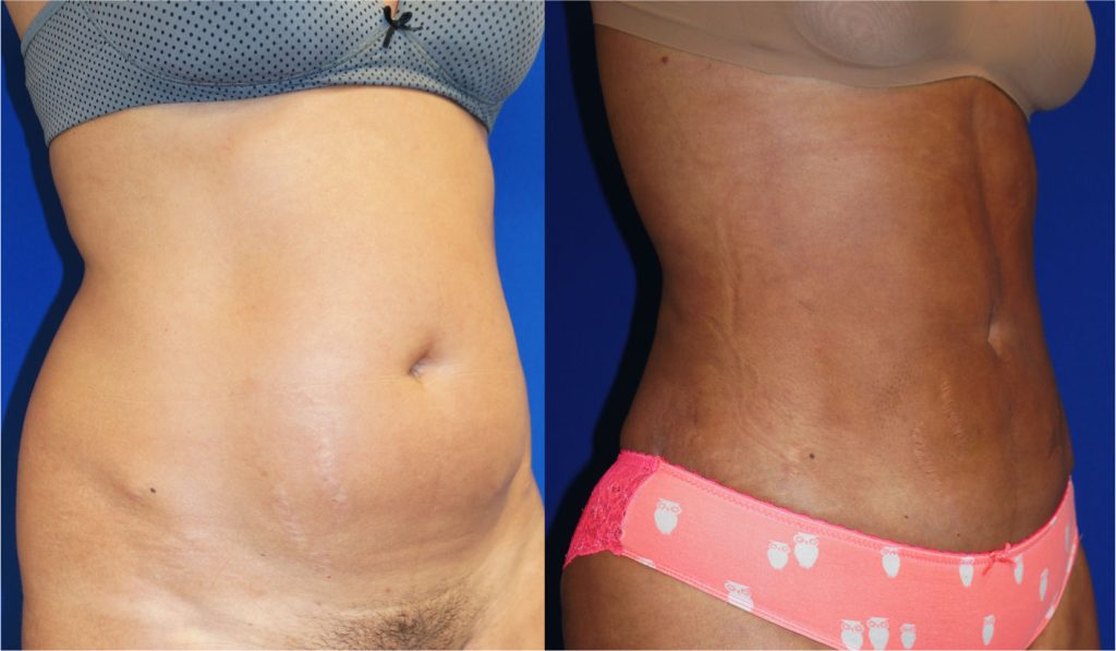 Liposuction of the abdomen, flanks, and lower back by Dr. Zuckerman. Patient, female, 1 months postop. Approximately 3.5 liters of fat removed. Fat grafting to the buttocks also performed. right oblique