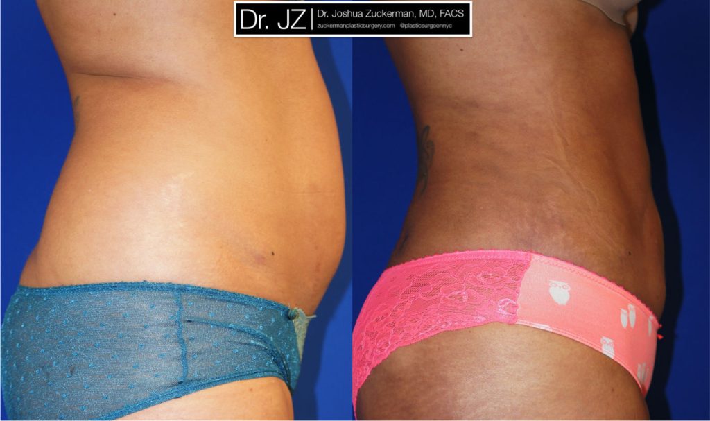 Liposuction of the abdomen, flanks, and lower back by Dr. Zuckerman. Patient, female, 1 months postop. Approximately 3.5 liters of fat removed. Fat grafting to the buttocks also performed. right profile