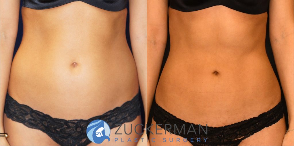 Liposuction of the abdomen, flanks, and lower back by Dr. Zuckerman. Patient, female, 2 months postop. Approximately 1 liters of fat removed. frontal