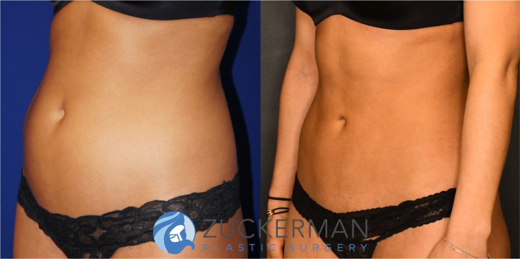 Liposuction of the abdomen, flanks, and lower back by Dr. Zuckerman. Patient, female, 2 months postop. Approximately 1 liters of fat removed. oblique