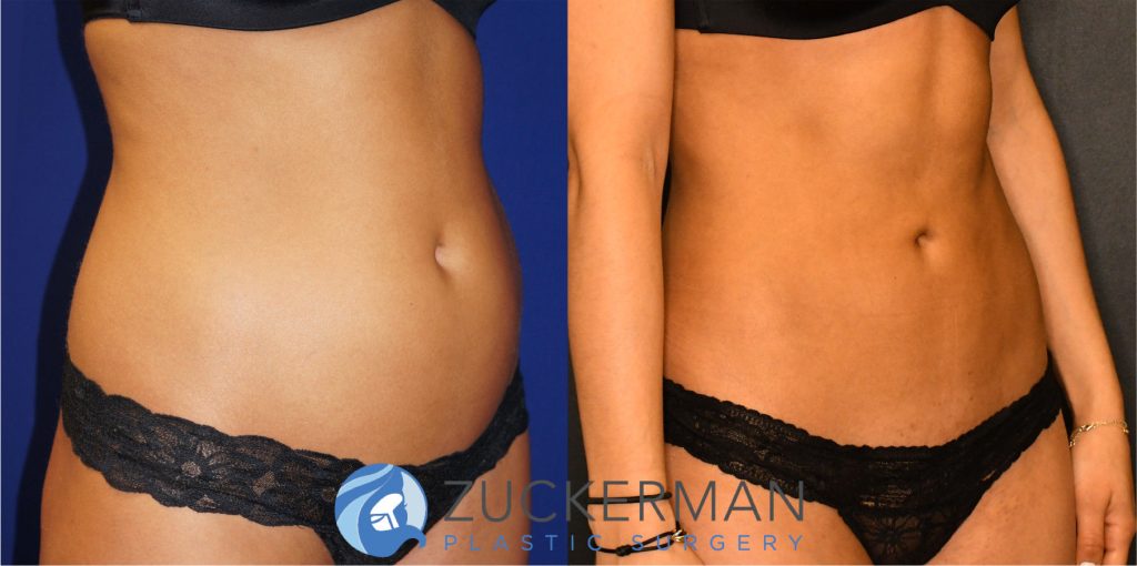 Liposuction of the abdomen, flanks, and lower back by Dr. Zuckerman. Patient, female, 2 months postop. Approximately 1 liters of fat removed. right oblique