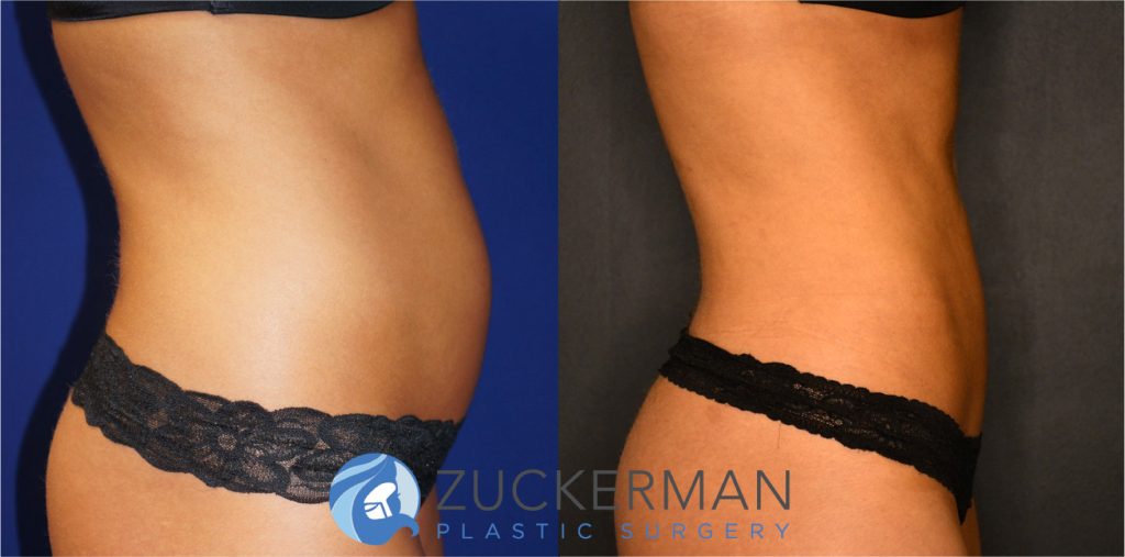 Liposuction of the abdomen, flanks, and lower back by Dr. Zuckerman. Patient, female, 2 months postop. Approximately 1 liters of fat removed. right profile