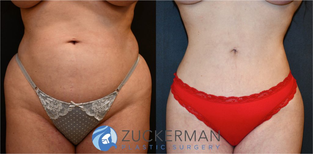 Liposuction of the abdomen, flanks, and lower back by Dr. Zuckerman. Patient, female, 2 months postop. Approximately 3 liters of fat removed. Fat grafting to the buttocks also performed. frontal