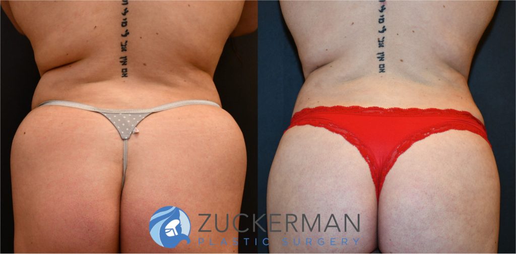 Liposuction of the abdomen, flanks, and lower back by Dr. Zuckerman. Patient, female, 2 months postop. Approximately 3 liters of fat removed. Fat grafting to the buttocks also performed. posterior