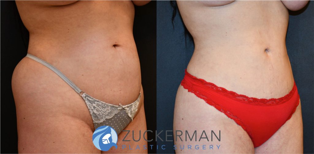 Liposuction of the abdomen, flanks, and lower back by Dr. Zuckerman. Patient, female, 2 months postop. Approximately 3 liters of fat removed. Fat grafting to the buttocks also performed. right oblique