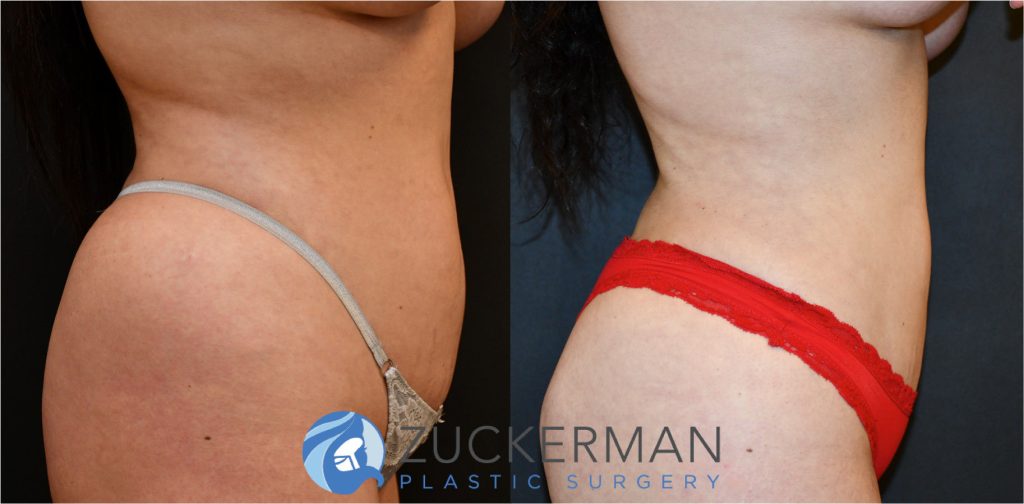 Liposuction of the abdomen, flanks, and lower back by Dr. Zuckerman. Patient, female, 2 months postop. Approximately 3 liters of fat removed. Fat grafting to the buttocks also performed. right profile