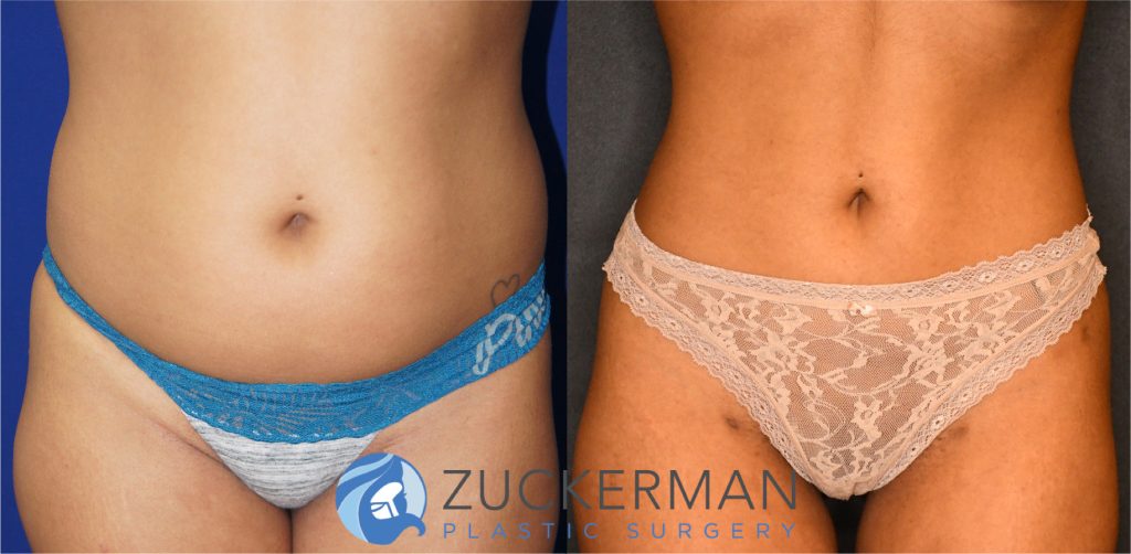 Liposuction of the abdomen, flanks, and lower back by Dr. Zuckerman. Patient, female, 2 months postop. Approximately 2-2.5 liters of fat removed. Fat grafting to the buttocks also performed. frontal