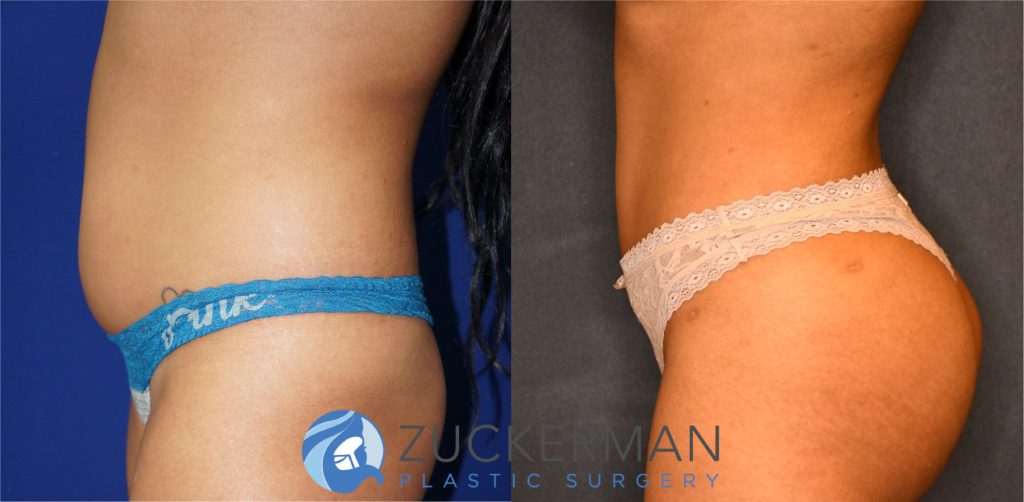 Liposuction of the abdomen, flanks, and lower back by Dr. Zuckerman. Patient, female, 2 months postop. Approximately 2-2.5 liters of fat removed. Fat grafting to the buttocks also performed. left profile