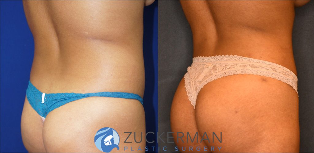 Liposuction of the abdomen, flanks, and lower back by Dr. Zuckerman. Patient, female, 2 months postop. Approximately 2-2.5 liters of fat removed. Fat grafting to the buttocks also performed. posterior right oblique