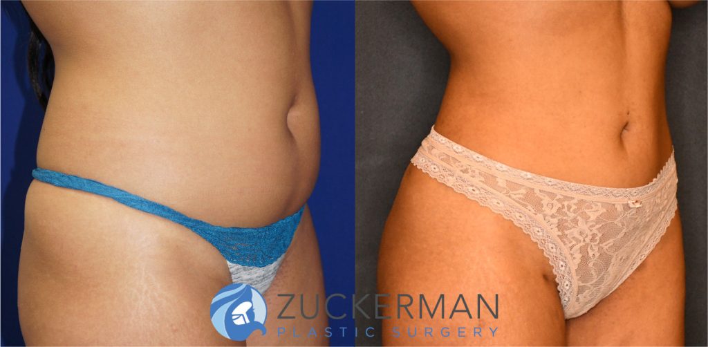 Liposuction of the abdomen, flanks, and lower back by Dr. Zuckerman. Patient, female, 2 months postop. Approximately 2-2.5 liters of fat removed. Fat grafting to the buttocks also performed. right oblique