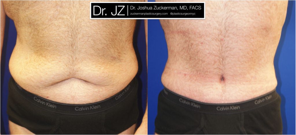 Tummy tuck surgery (abdominoplasty) by Dr. Zuckerman. Post-weight loss patient, male, 2 months postop. Patient had lost 100 lbs prior to surgery. frontal