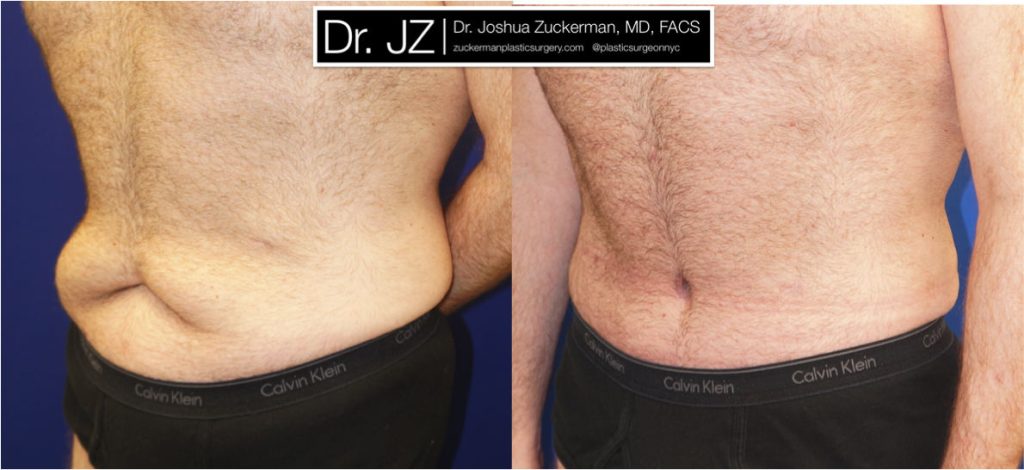 Tummy tuck surgery (abdominoplasty) by Dr. Zuckerman. Post-weight loss patient, male, 2 months postop. Patient had lost 100 lbs prior to surgery. left oblique