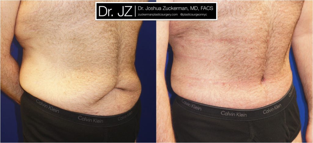 Tummy tuck surgery (abdominoplasty) by Dr. Zuckerman. Post-weight loss patient, male, 2 months postop. Patient had lost 100 lbs prior to surgery. right oblique