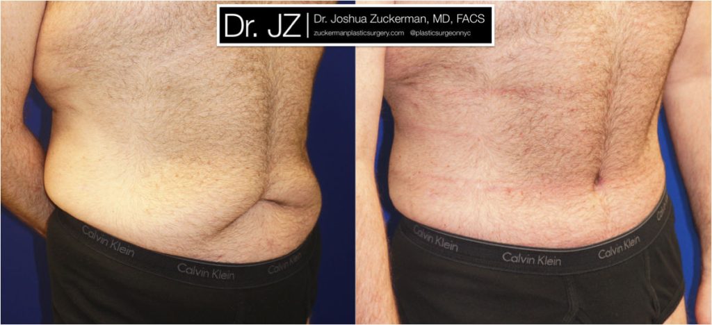 male abdominoplasty right oblique