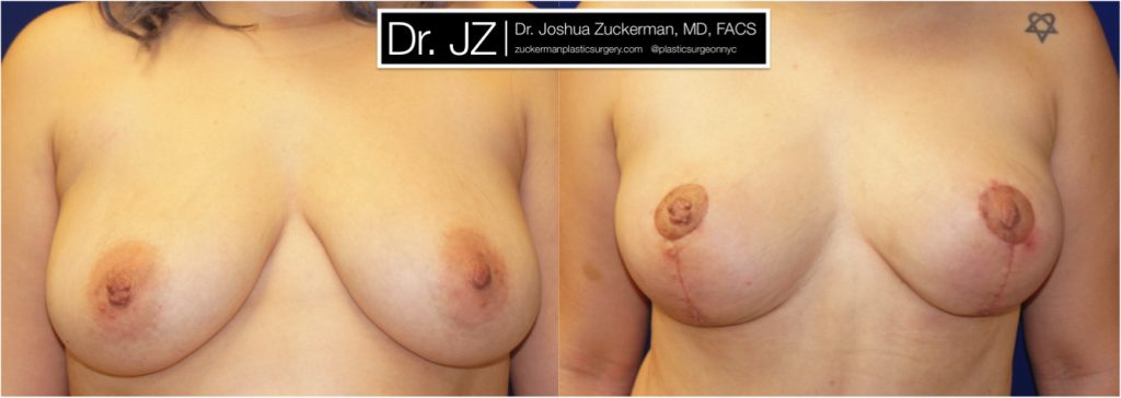 Breast lift (mastopexy) by Dr. Zuckerman. Patient, female, 1.5 months postop. Vertical breast lift. frontal