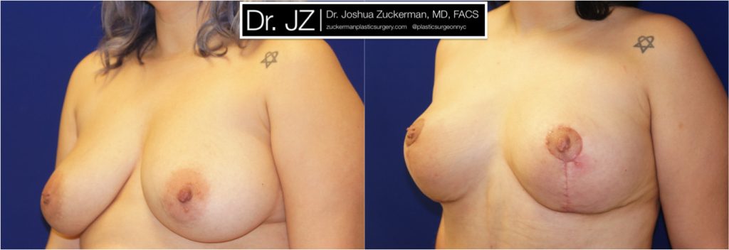 Breast lift (mastopexy) by Dr. Zuckerman. Patient, female, 1.5 months postop. Vertical breast lift. left oblique