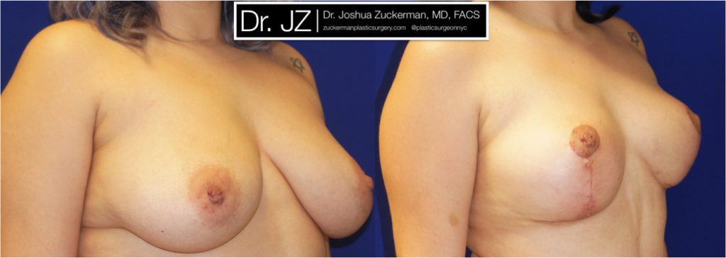 Breast lift (mastopexy) by Dr. Zuckerman. Patient, female, 1.5 months postop. Vertical breast lift. right oblique