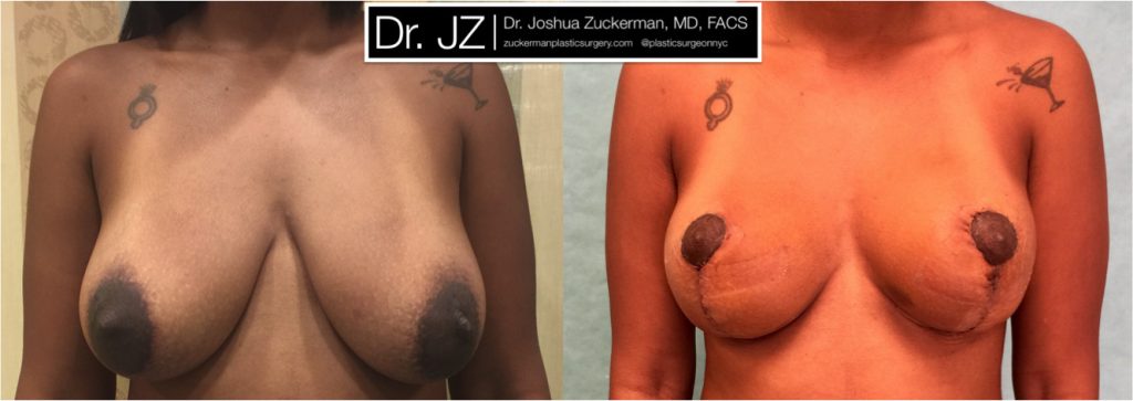 Early breast lift (mastopexy) by Dr. Zuckerman. Patient, female, 1 week postop. Scars will fade to a thin, almost invisible, line, with final result at 12mos. frontal