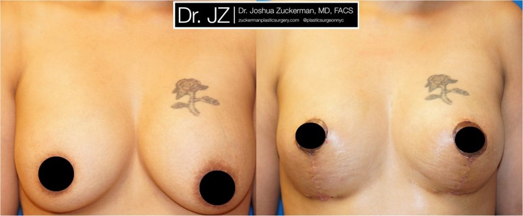 Breast lift (mastopexy) by Dr. Zuckerman. Patient, female, 1 month postop. Mastopexy around existing breast implants. Corrected significant, Grade II, ptosis (sag) of the breasts. frontal