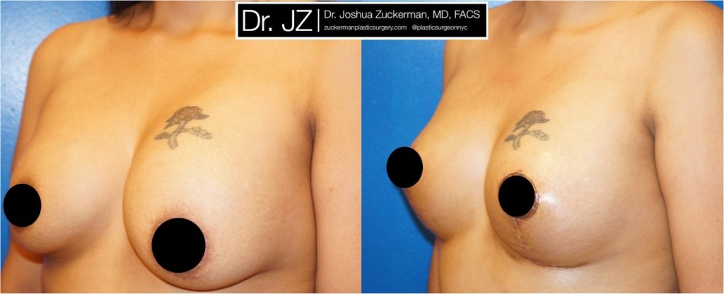 Breast lift (mastopexy) by Dr. Zuckerman. Patient, female, 1 month postop. Mastopexy around existing breast implants. Corrected significant, Grade II, ptosis (sag) of the breasts. left oblique