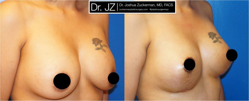 Breast lift (mastopexy) by Dr. Zuckerman. Patient, female, 1 month postop. Mastopexy around existing breast implants. Corrected significant, Grade II, ptosis (sag) of the breasts. right oblique