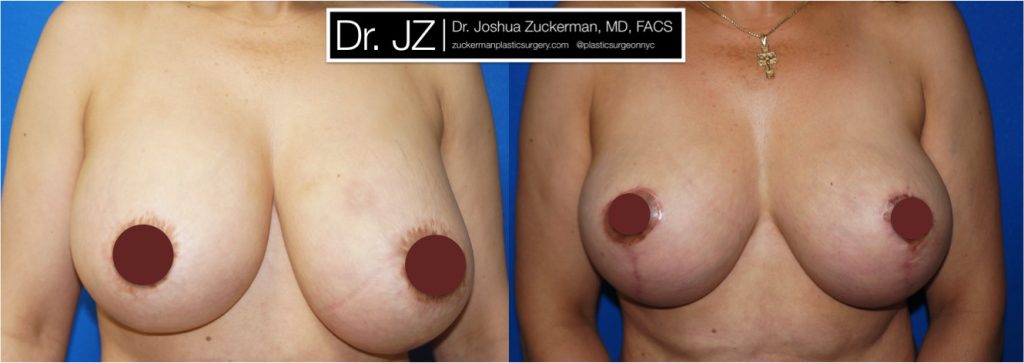 Breast Lift (mastopexy) and breast implant removal by Dr. Zuckerman. Patient, female, 1 month postop, vertical breast lift. frontal