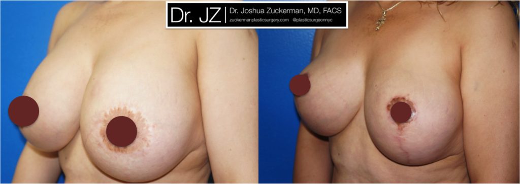 Breast Lift (mastopexy) and breast implant removal by Dr. Zuckerman. Patient, female, 1 month postop, vertical breast lift. left oblique