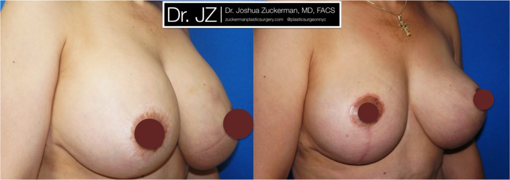 Breast Lift (mastopexy) and breast implant removal by Dr. Zuckerman. Patient, female, 1 month postop, vertical breast lift. right oblique