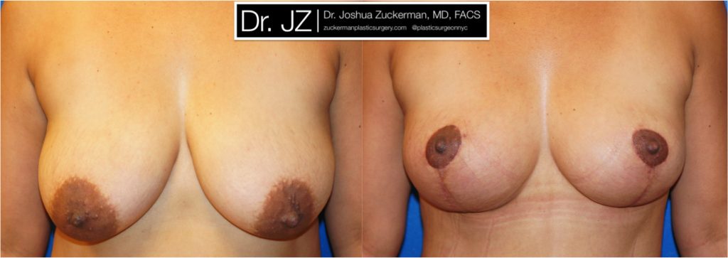 Breast lift (mastopexy) by Dr. Zuckerman. Patient, female, 1 month postop. Vertical breast lift. frontal