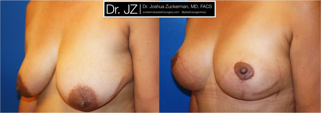 Breast lift (mastopexy) by Dr. Zuckerman. Patient, female, 1 month postop. Vertical breast lift. left oblique