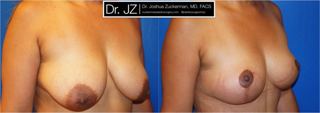 Breast lift (mastopexy) by Dr. Zuckerman. Patient, female, 1 month postop. Vertical breast lift. right oblique