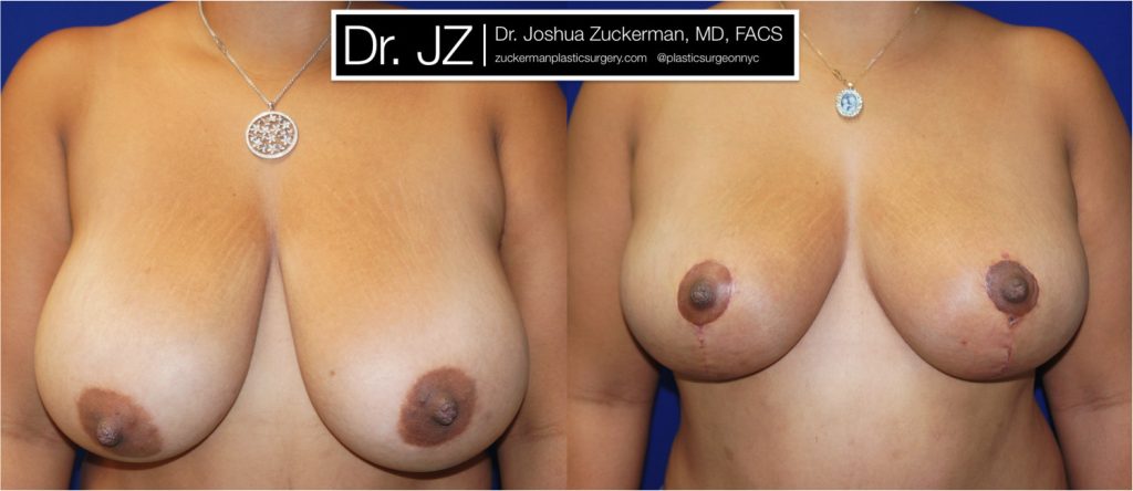 Breast lift (mastopexy) by Dr. Zuckerman. Patient, female, 1 month postop. Vertical breast lift. frontal