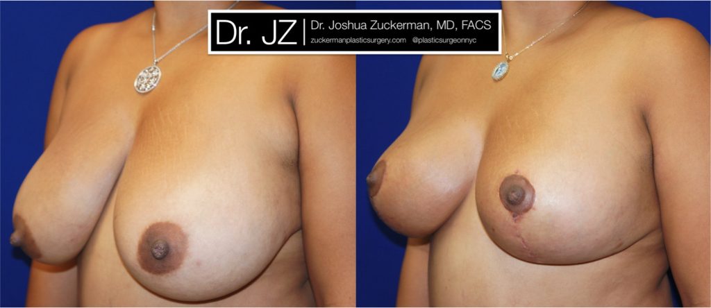 Breast lift (mastopexy) by Dr. Zuckerman. Patient, female, 1 month postop. Vertical breast lift. left oblique