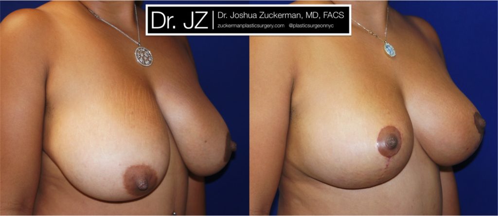 Breast lift (mastopexy) by Dr. Zuckerman. Patient, female, 1 month postop. Vertical breast lift. right oblique