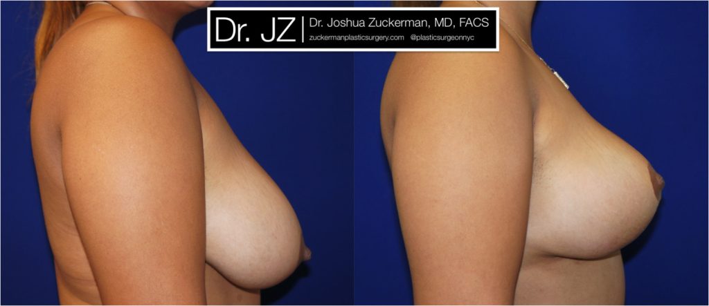 Breast lift (mastopexy) by Dr. Zuckerman. Patient, female, 1 month postop. Vertical breast lift. right profile