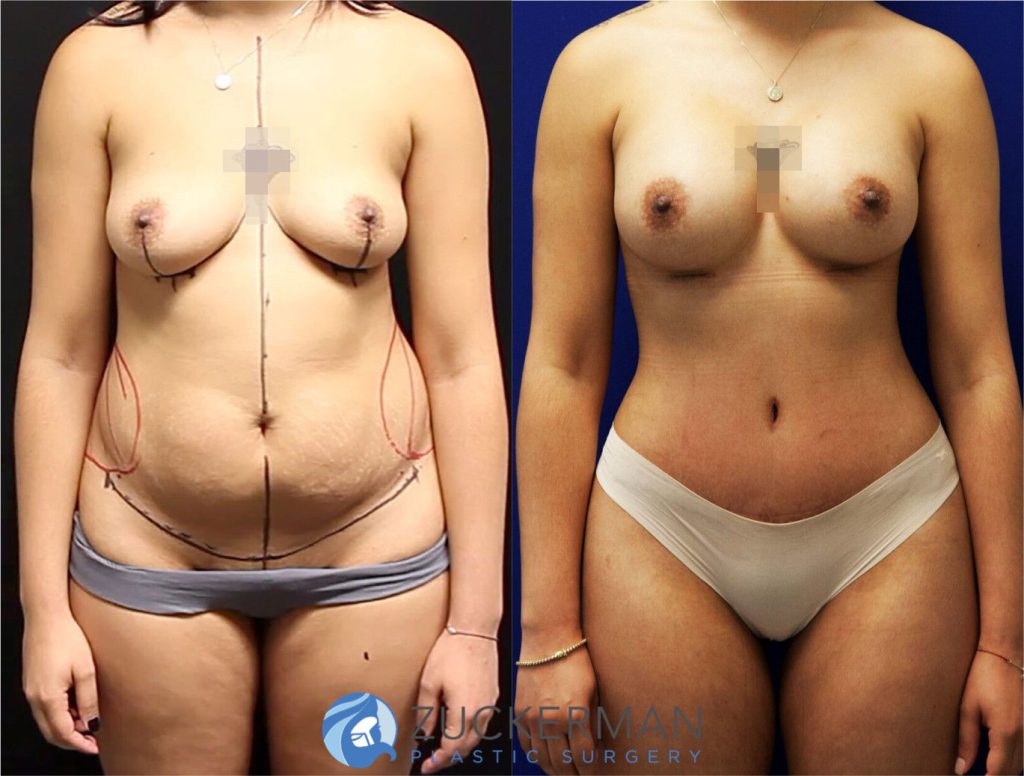 Mommy makeover by Dr. Zuckerman. Female patient, 2 months postop. Breast augmentation with 300cc Mentor Round silicone implants and tummy tuck (abdominoplasty) with liposuction of abdomen and flanks. frontal