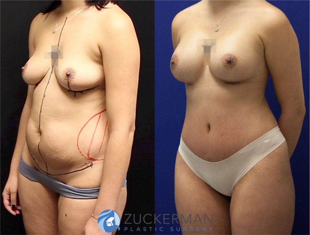 Mommy makeover by Dr. Zuckerman. Female patient, 2 months postop. Breast augmentation with 300cc Mentor Round silicone implants and tummy tuck (abdominoplasty) with liposuction of abdomen and flanks. left oblique