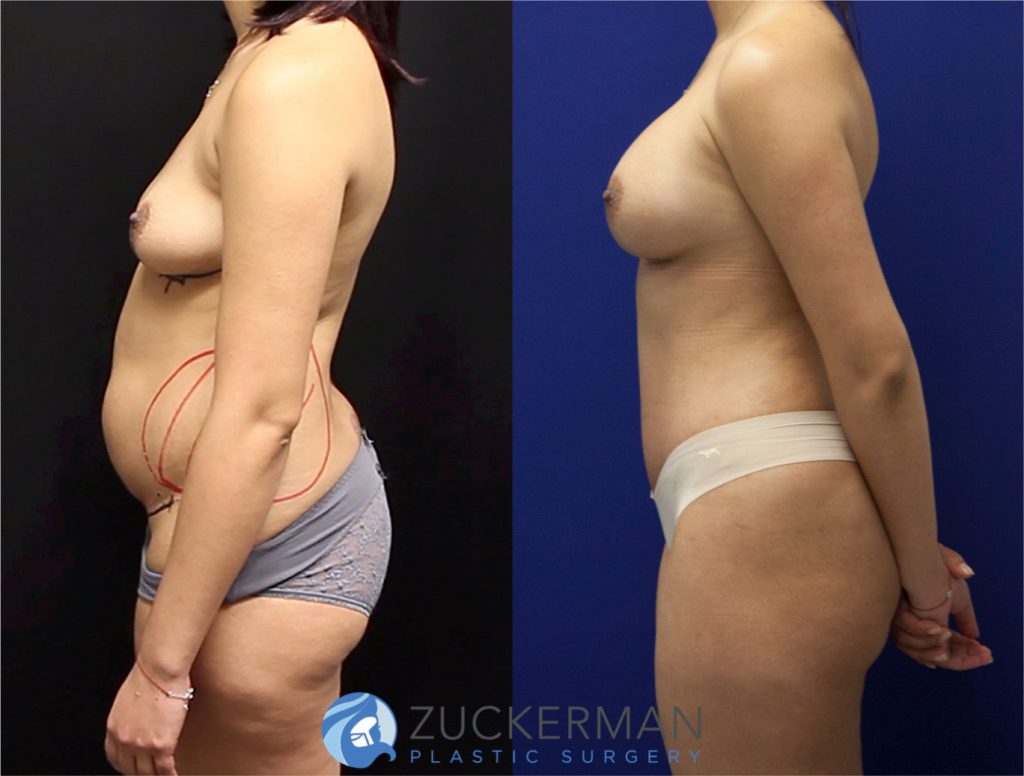 Mommy makeover by Dr. Zuckerman. Female patient, 2 months postop. Breast augmentation with 300cc Mentor Round silicone implants and tummy tuck (abdominoplasty) with liposuction of abdomen and flanks. left profile