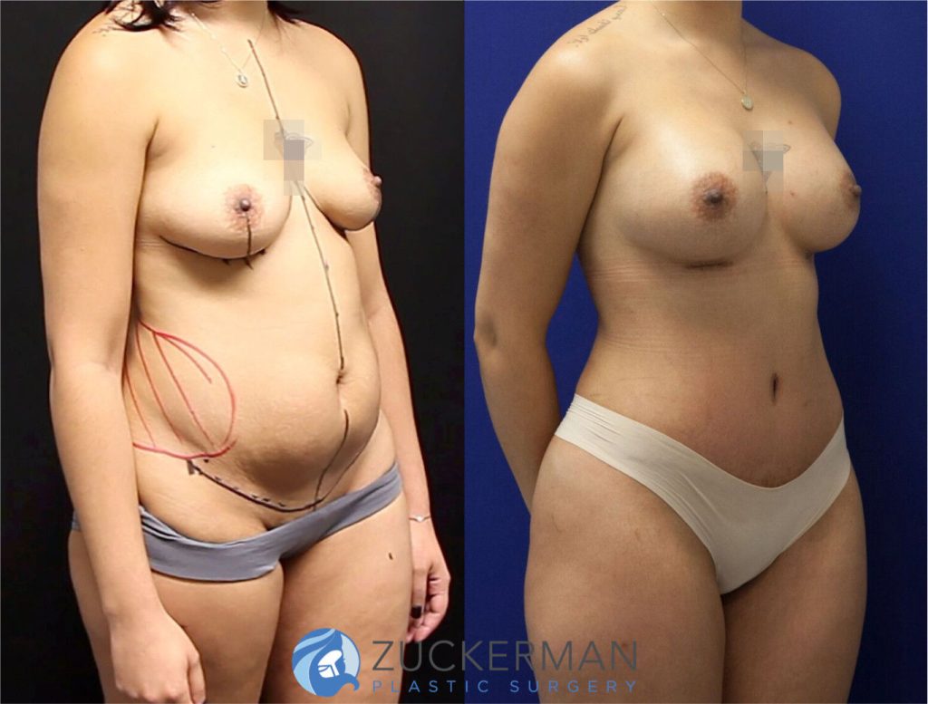 Mommy makeover by Dr. Zuckerman. Female patient, 2 months postop. Breast augmentation with 300cc Mentor Round silicone implants and tummy tuck (abdominoplasty) with liposuction of abdomen and flanks. right oblique