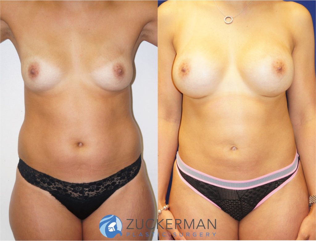 Mommy makeover by Dr. Zuckerman. Female patient, 6 months postop. Breast augmentation with 350cc Mentor round silicone gel implants and liposuction of abdomen and flanks. frontal