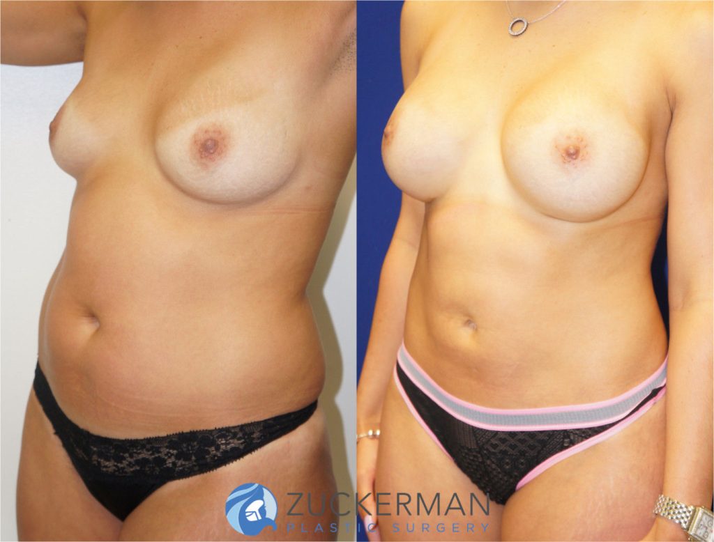 Mommy makeover by Dr. Zuckerman. Female patient, 6 months postop. Breast augmentation with 350cc Mentor round silicone gel implants and liposuction of abdomen and flanks. left oblique