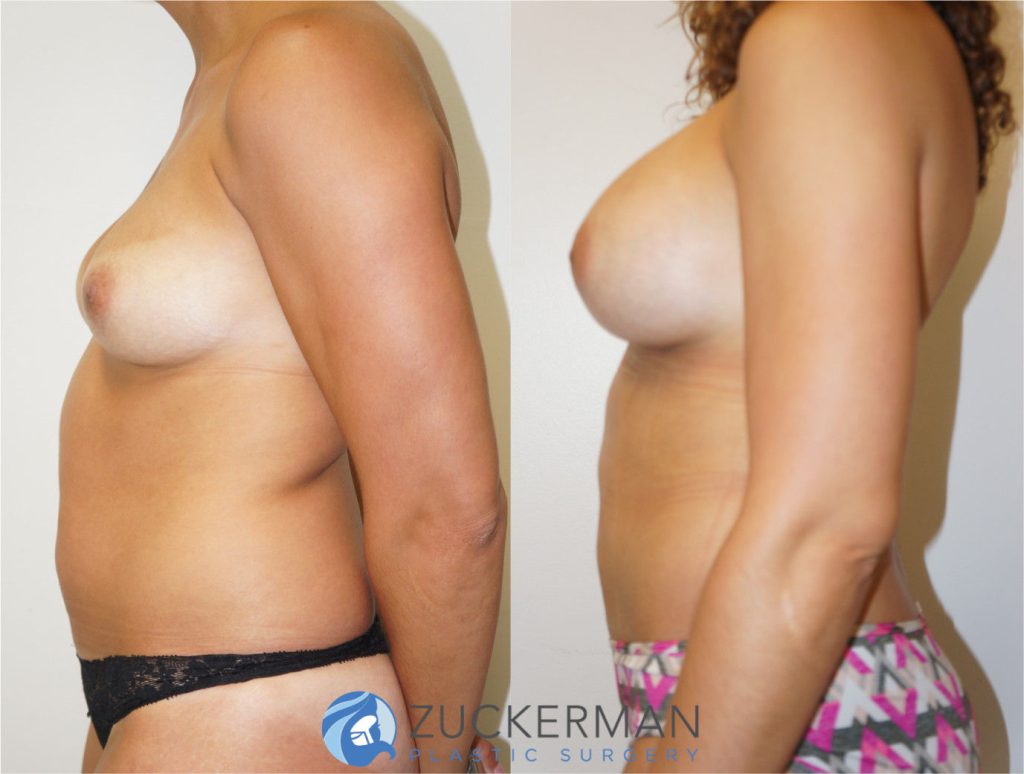 Mommy makeover by Dr. Zuckerman. Female patient, 6 months postop. Breast augmentation with 350cc Mentor round silicone gel implants and liposuction of abdomen and flanks. left profile