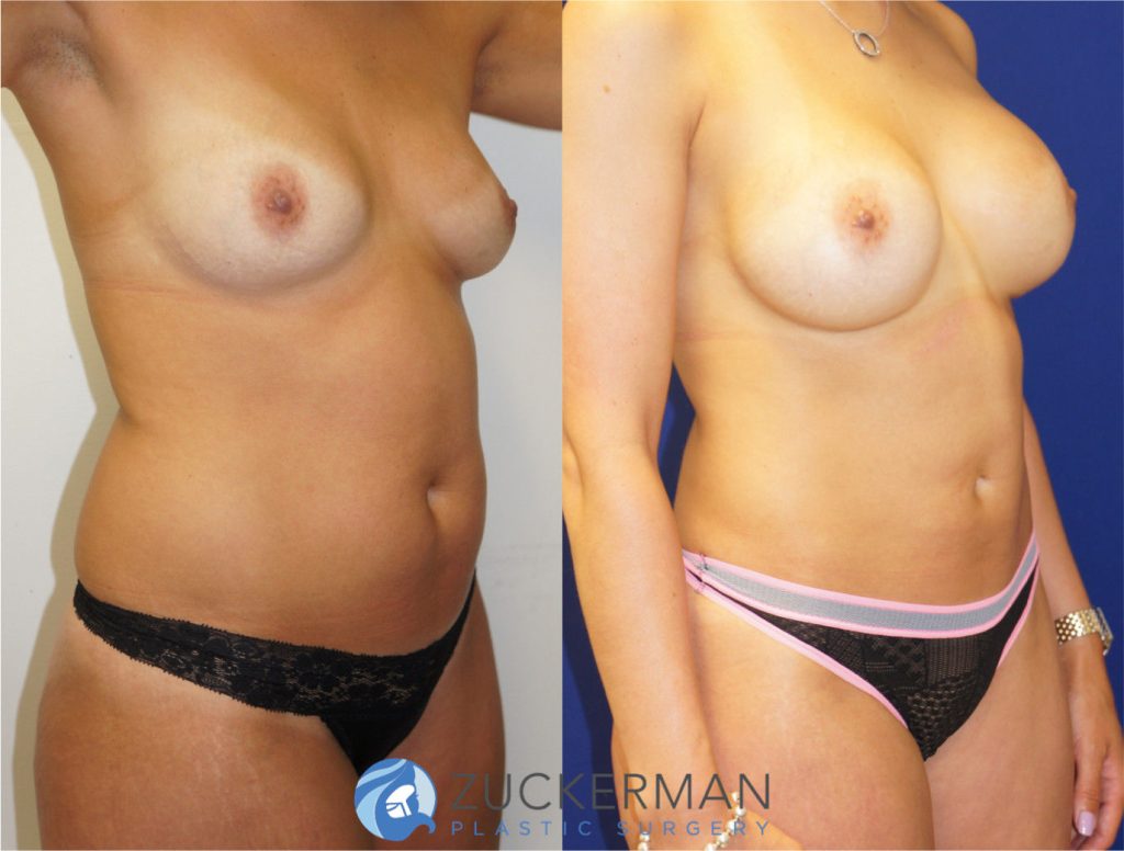 Mommy makeover by Dr. Zuckerman. Female patient, 6 months postop. Breast augmentation with 350cc Mentor round silicone gel implants and liposuction of abdomen and flanks. right oblique