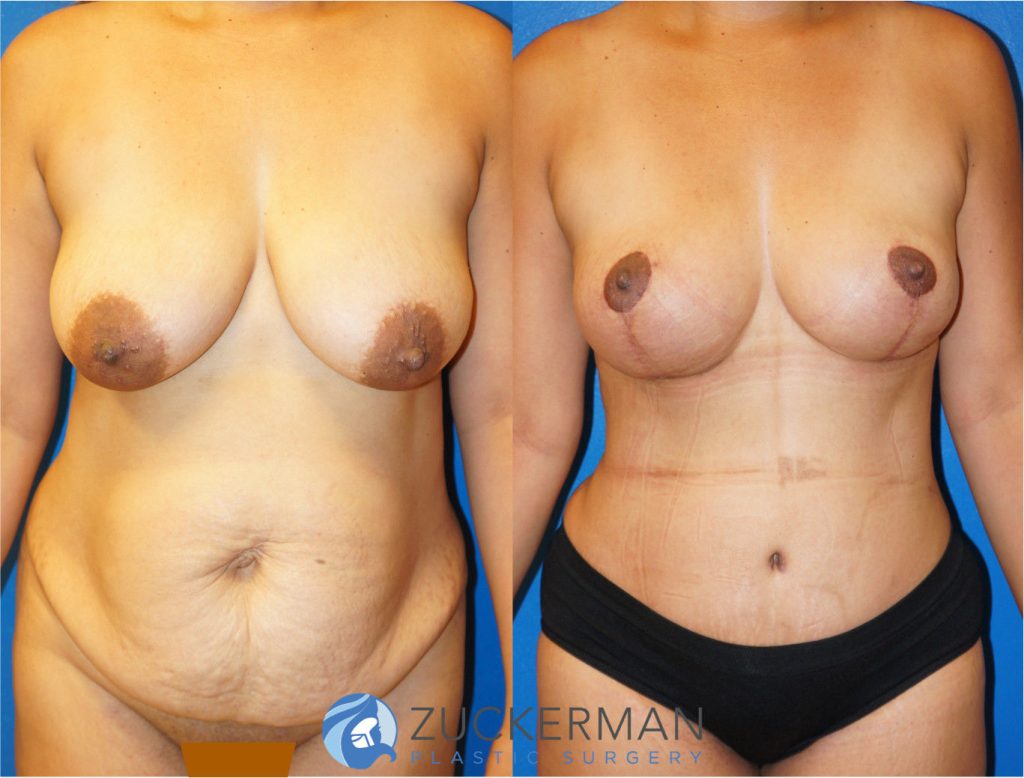 Mommy makeover by Dr. Zuckerman. Female patient 1 month postop. Vertical breast lift (mastopexy) and tummy tuck (abdominoplasty) with liposuction of abdomen and flanks. frontal