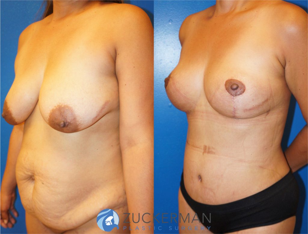 Mommy makeover by Dr. Zuckerman. Female patient 1 month postop. Vertical breast lift (mastopexy) and tummy tuck (abdominoplasty) with liposuction of abdomen and flanks. left oblique