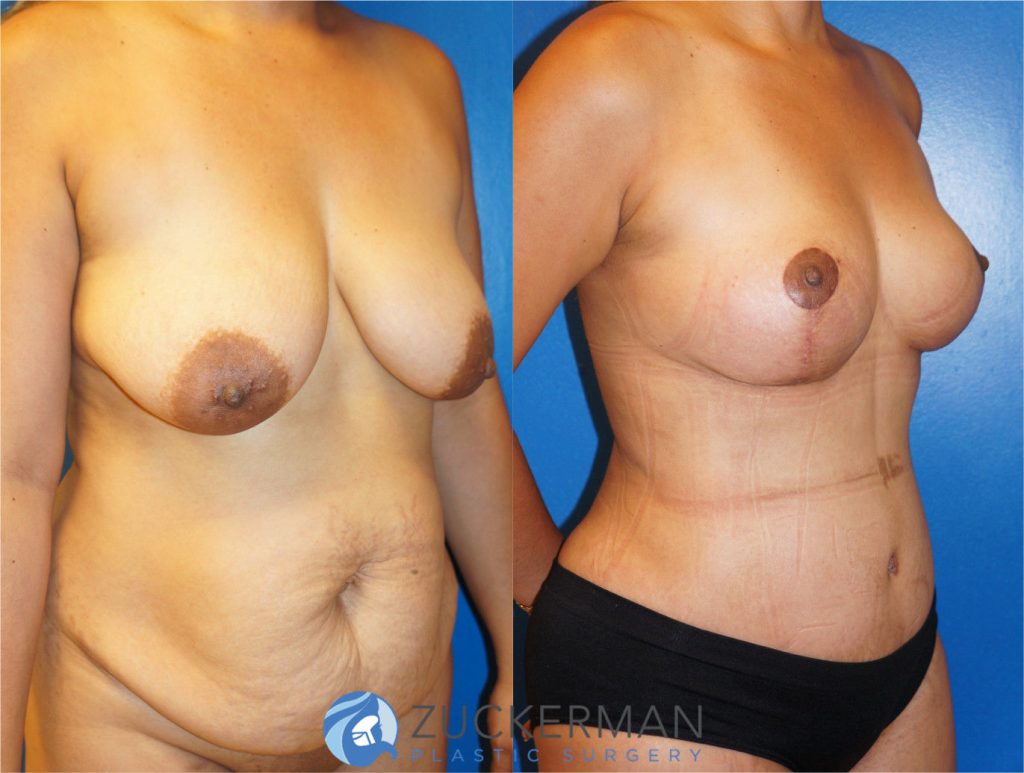 Mommy makeover by Dr. Zuckerman. Female patient 1 month postop. Vertical breast lift (mastopexy) and tummy tuck (abdominoplasty) with liposuction of abdomen and flanks. right oblique