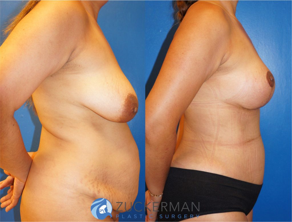 Mommy makeover by Dr. Zuckerman. Female patient 1 month postop. Vertical breast lift (mastopexy) and tummy tuck (abdominoplasty) with liposuction of abdomen and flanks. right profile