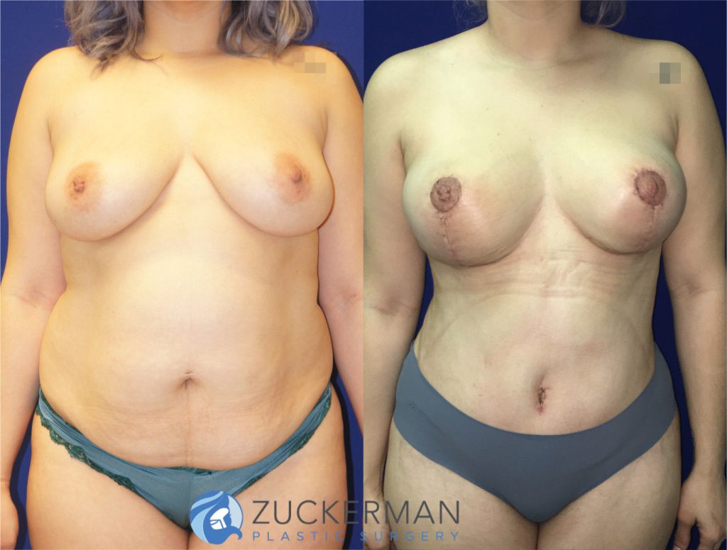 Mommy makeover by Dr. Zuckerman. Female patient, 4 months postop. Vertical breast lift (mastopexy) and tummy tuck (abdominoplasty) with liposuction of abdomen and flanks. frontal