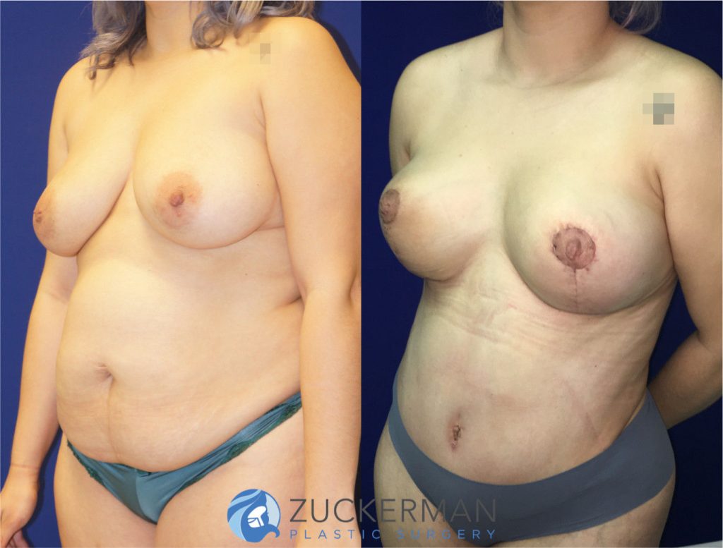 Mommy makeover by Dr. Zuckerman. Female patient, 4 months postop. Vertical breast lift (mastopexy) and tummy tuck (abdominoplasty) with liposuction of abdomen and flanks. left oblique